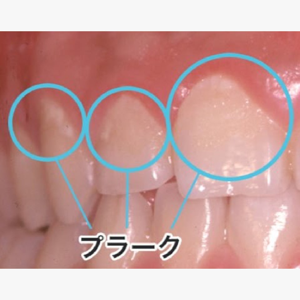 歯面のプラーク（菌の塊）を除去する