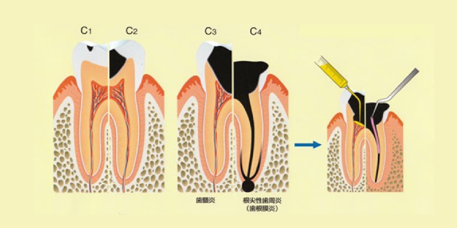 むし歯の進行と治療方法
