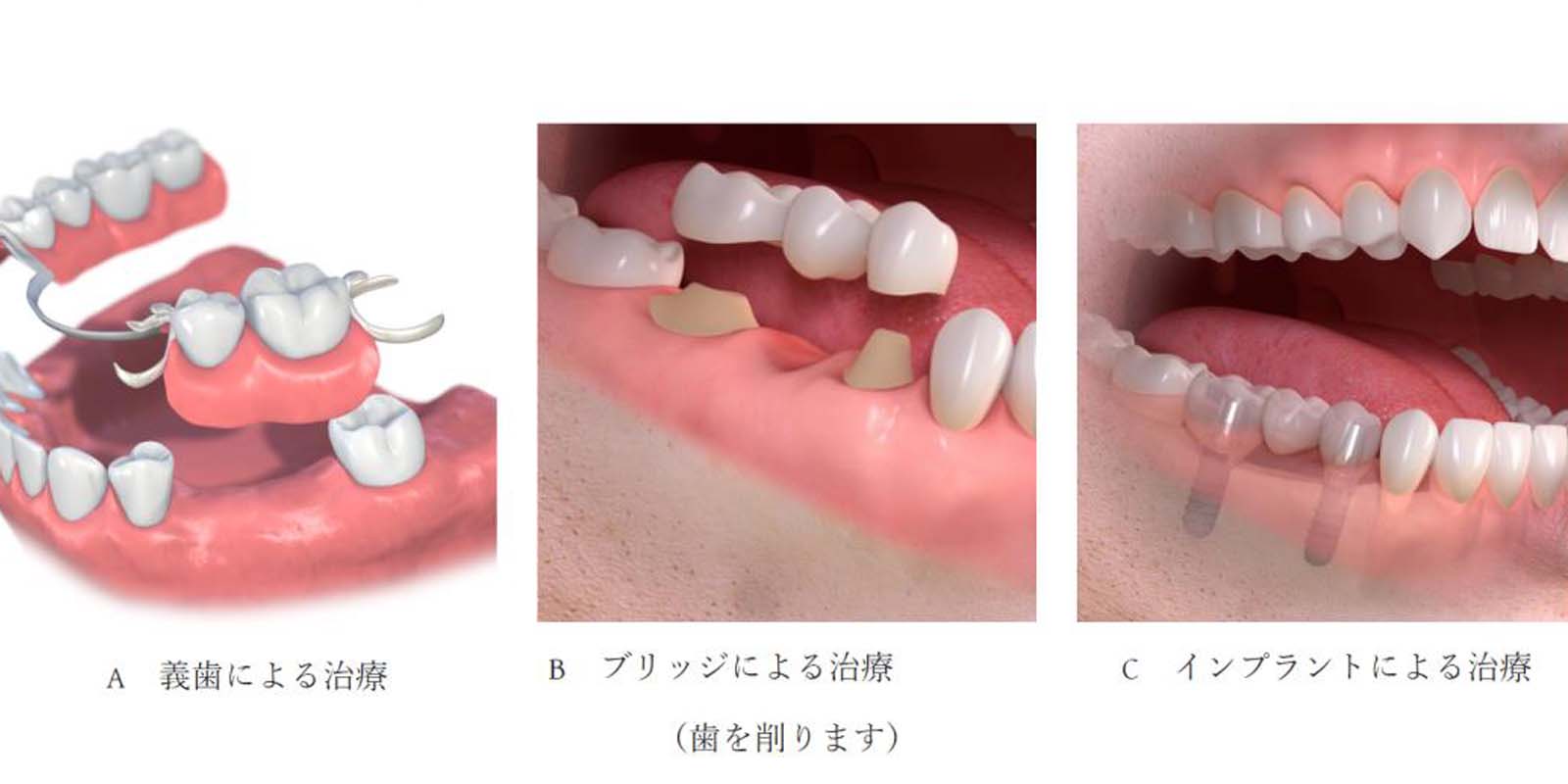 インプラントの欠点